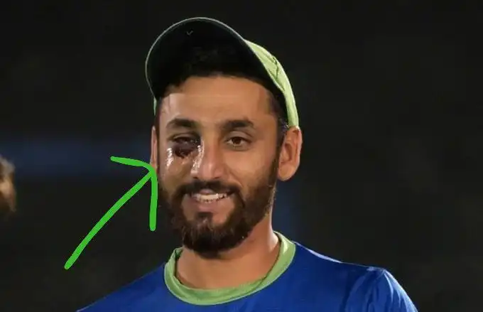 Pakistan Cricketer Agha Salman's Scary Picture Surfaces After Being Hit On Face vs India
